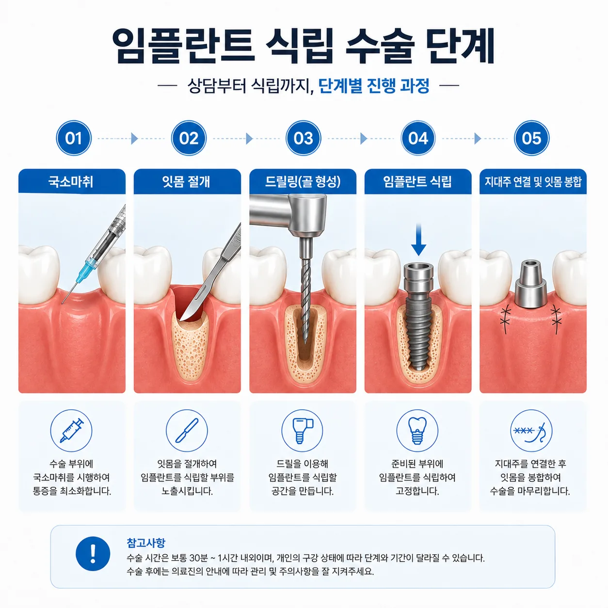 국소마취 잇몸 절개 드릴링 임플란트 식립 봉합 순서 일러스트