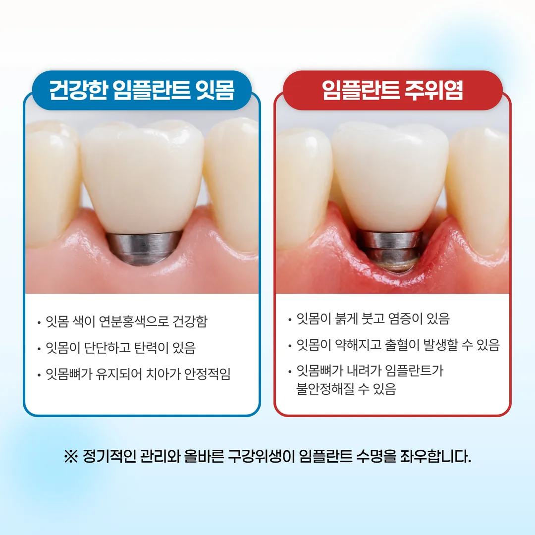 임플란트 주위염 정상 잇몸 비교