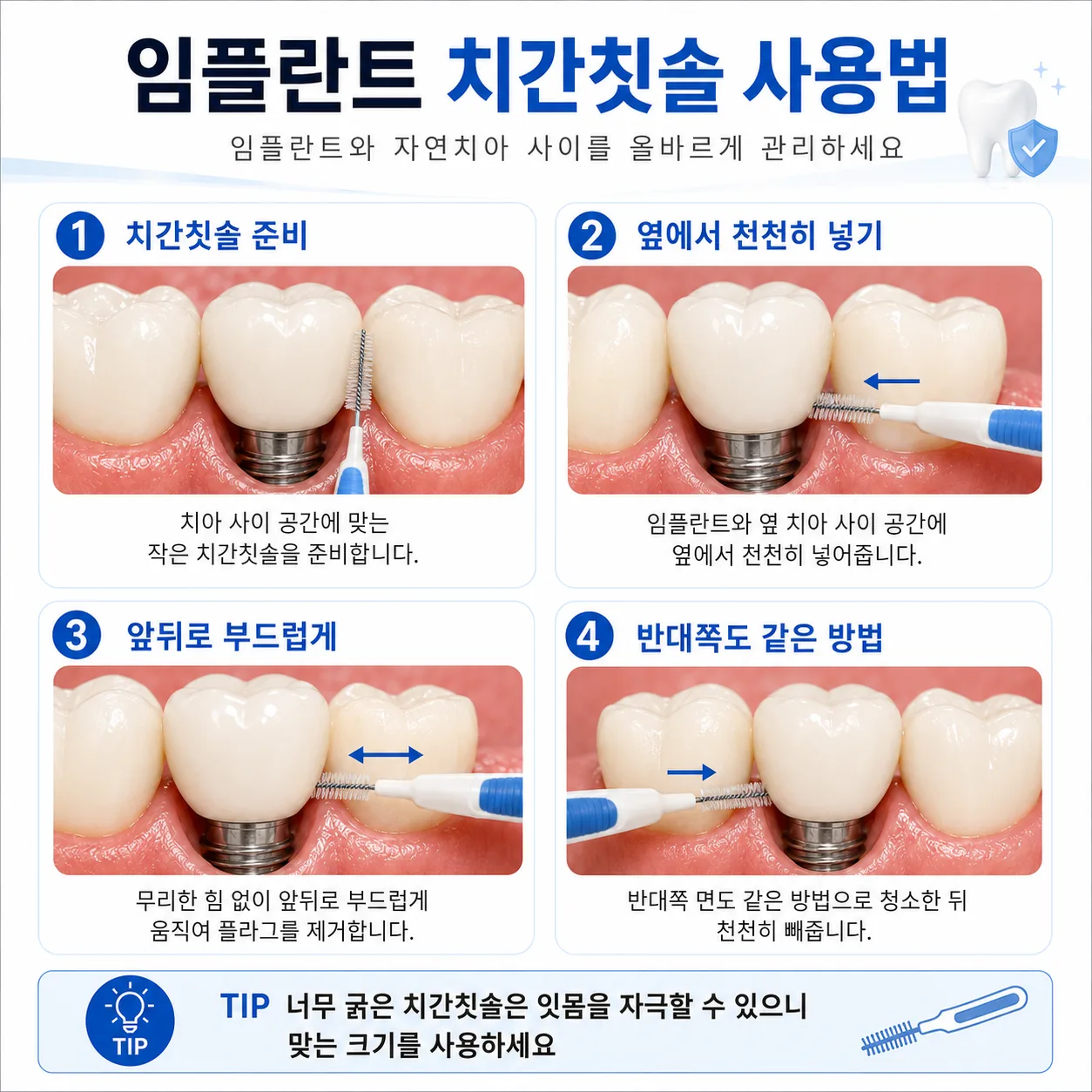 임플란트 치간칫솔 치실 사용법