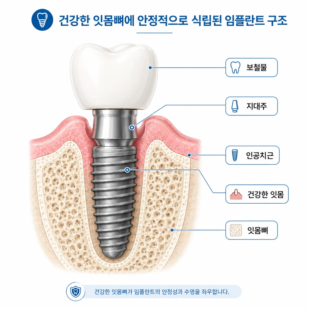 임플란트 구조 모식도 - 인공치근 지대주 보철물