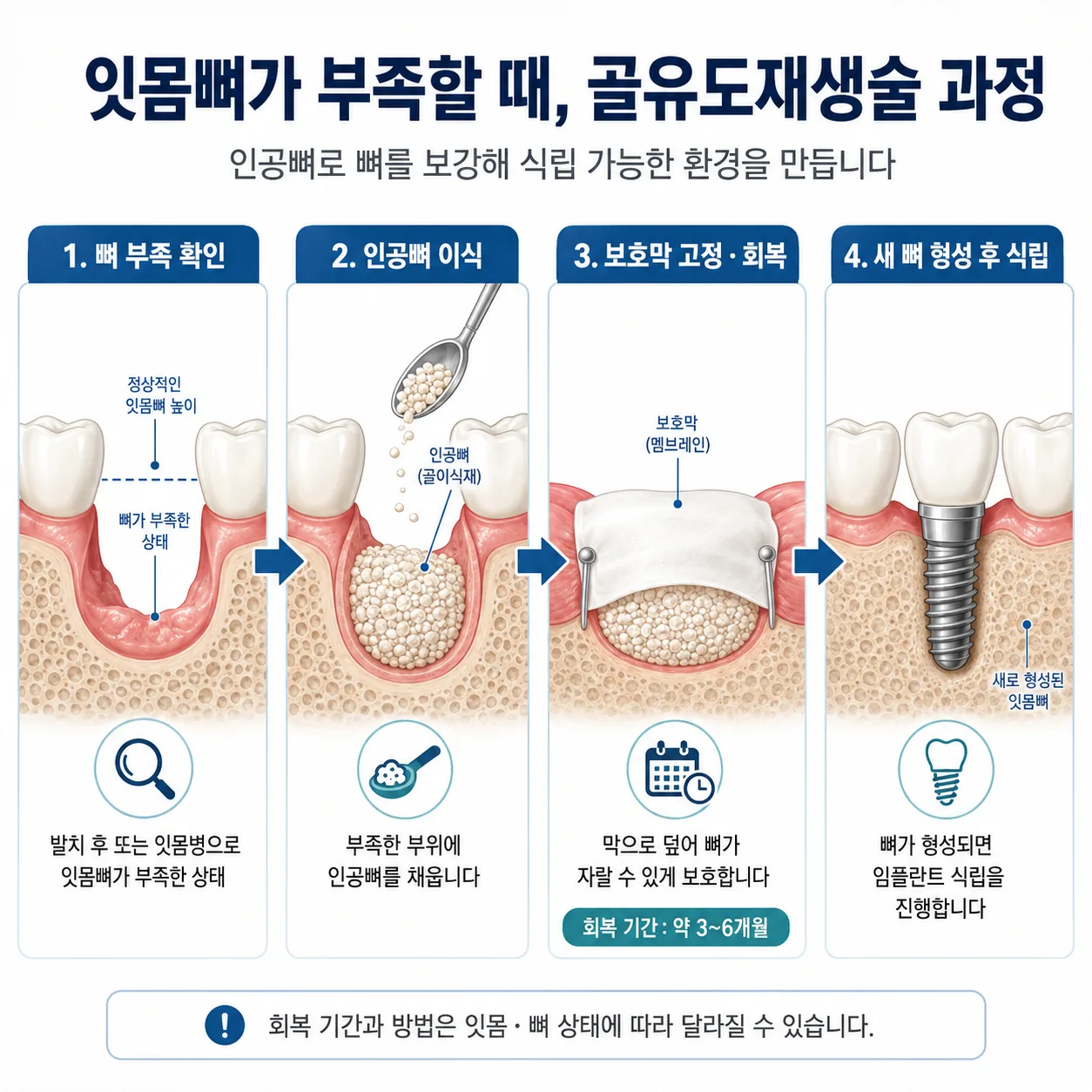 골유도재생술 - 잇몸뼈 부족 시 골이식 과정