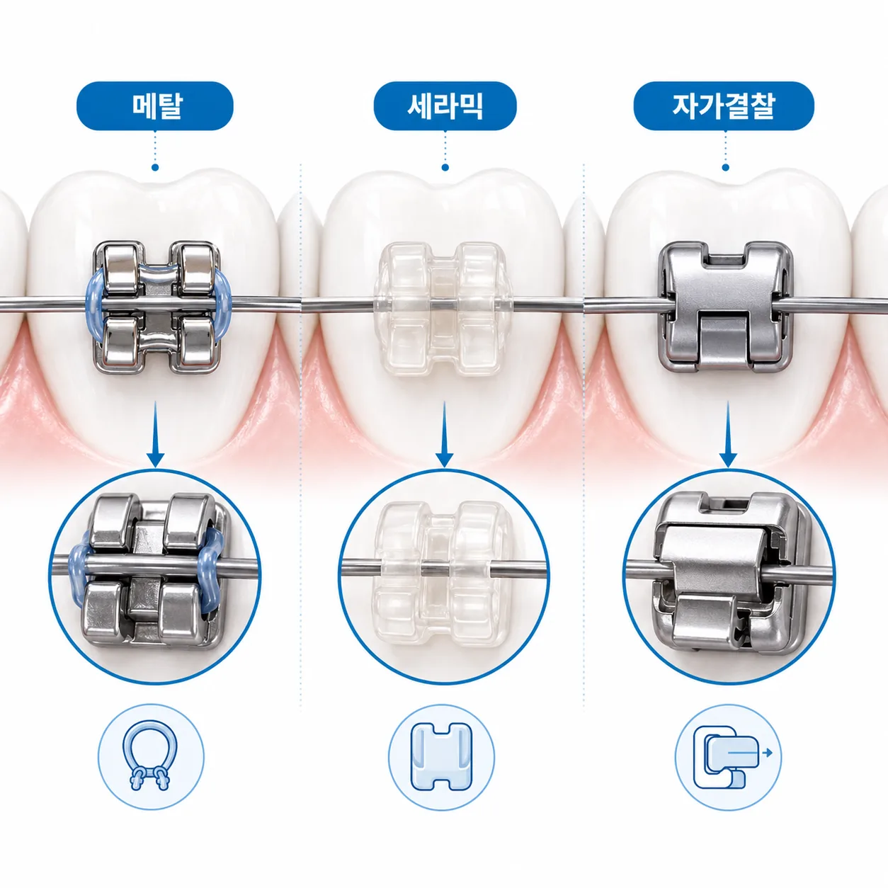 메탈 세라믹 자가결찰 브라켓 구조 비교 일러스트