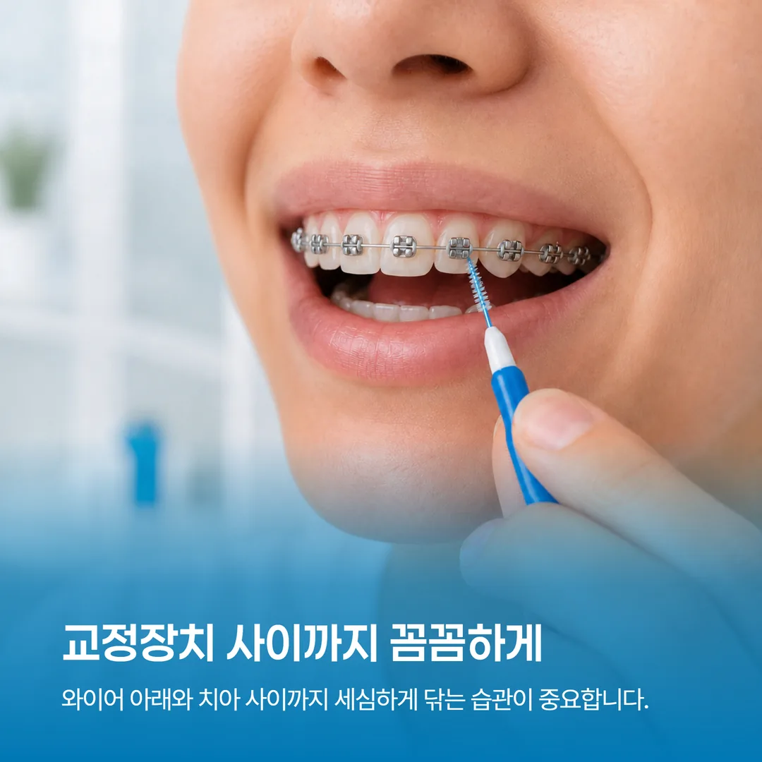 교정장치 착용 중 교정용 칫솔과 치간칫솔로 양치하는 방법