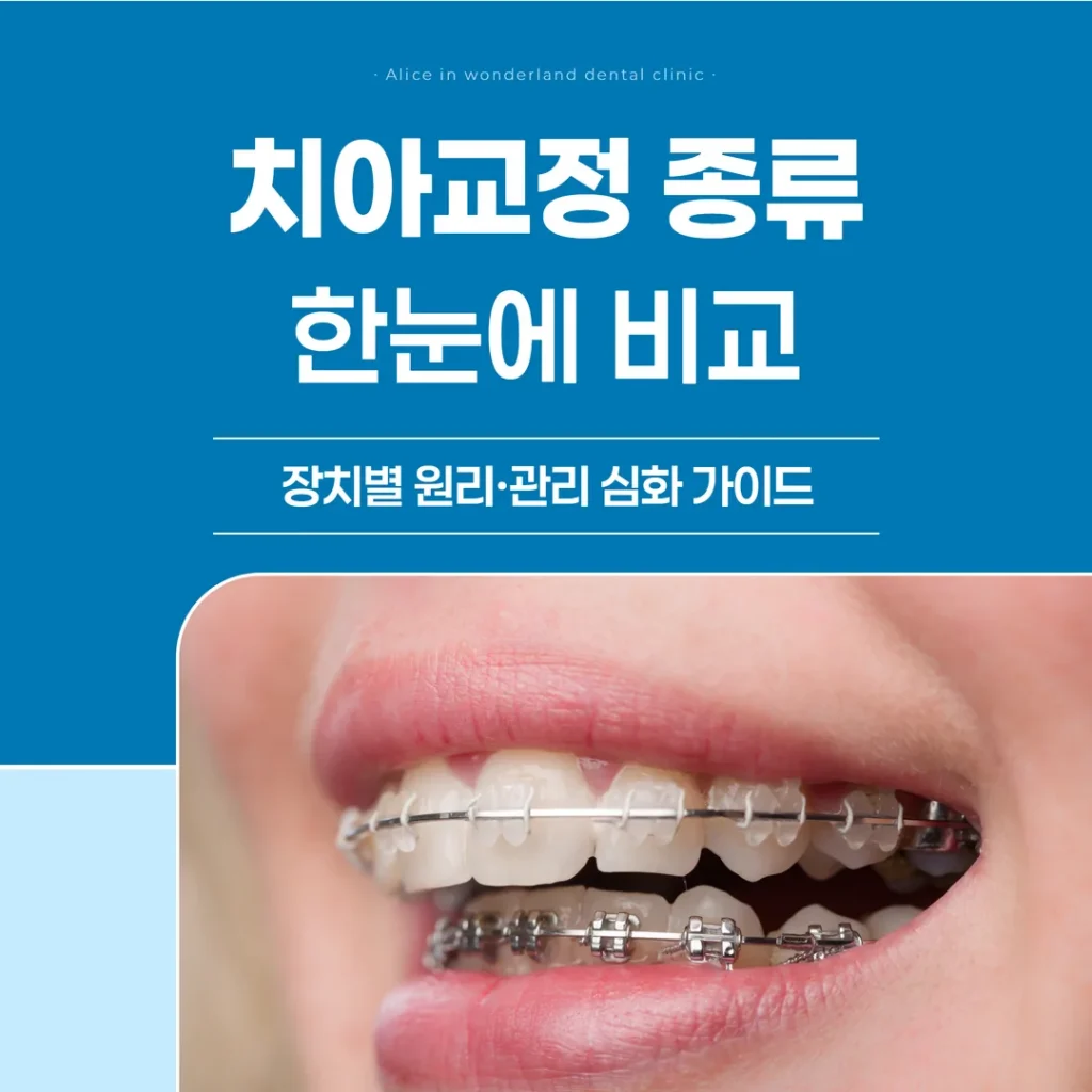 치아교정 종류(투명·메탈·설측) 한눈에 비교 — 장치별 원리·관리 심화 가이드