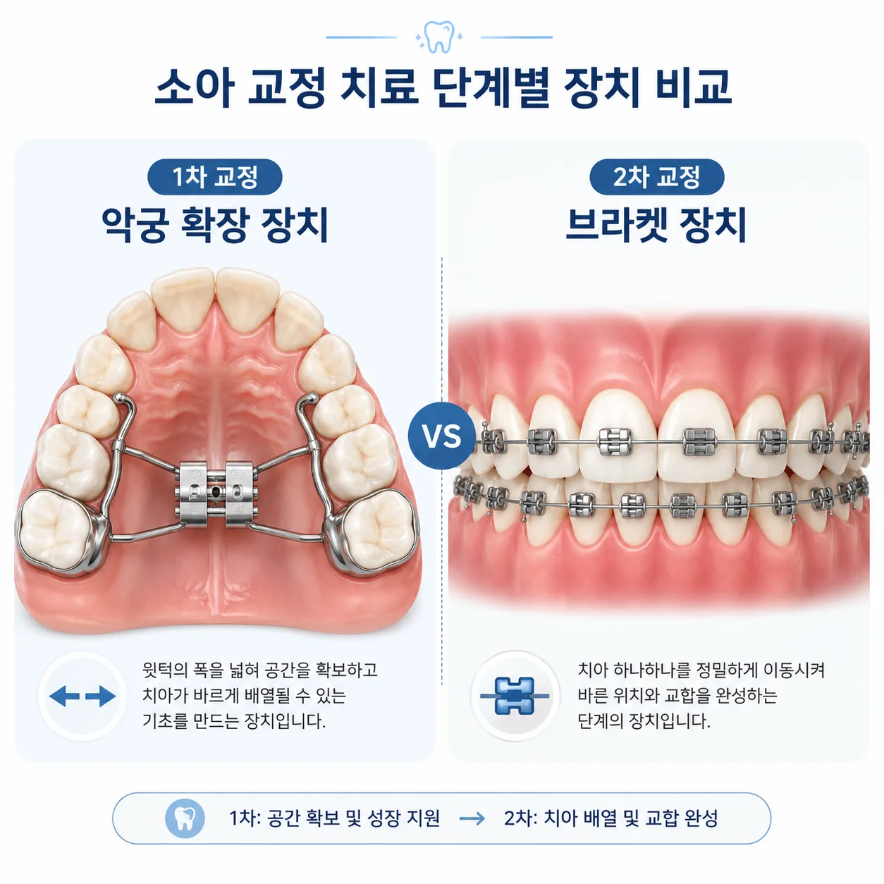 어린이 치아교정 1차 교정 장치와 2차 교정 장치 비교