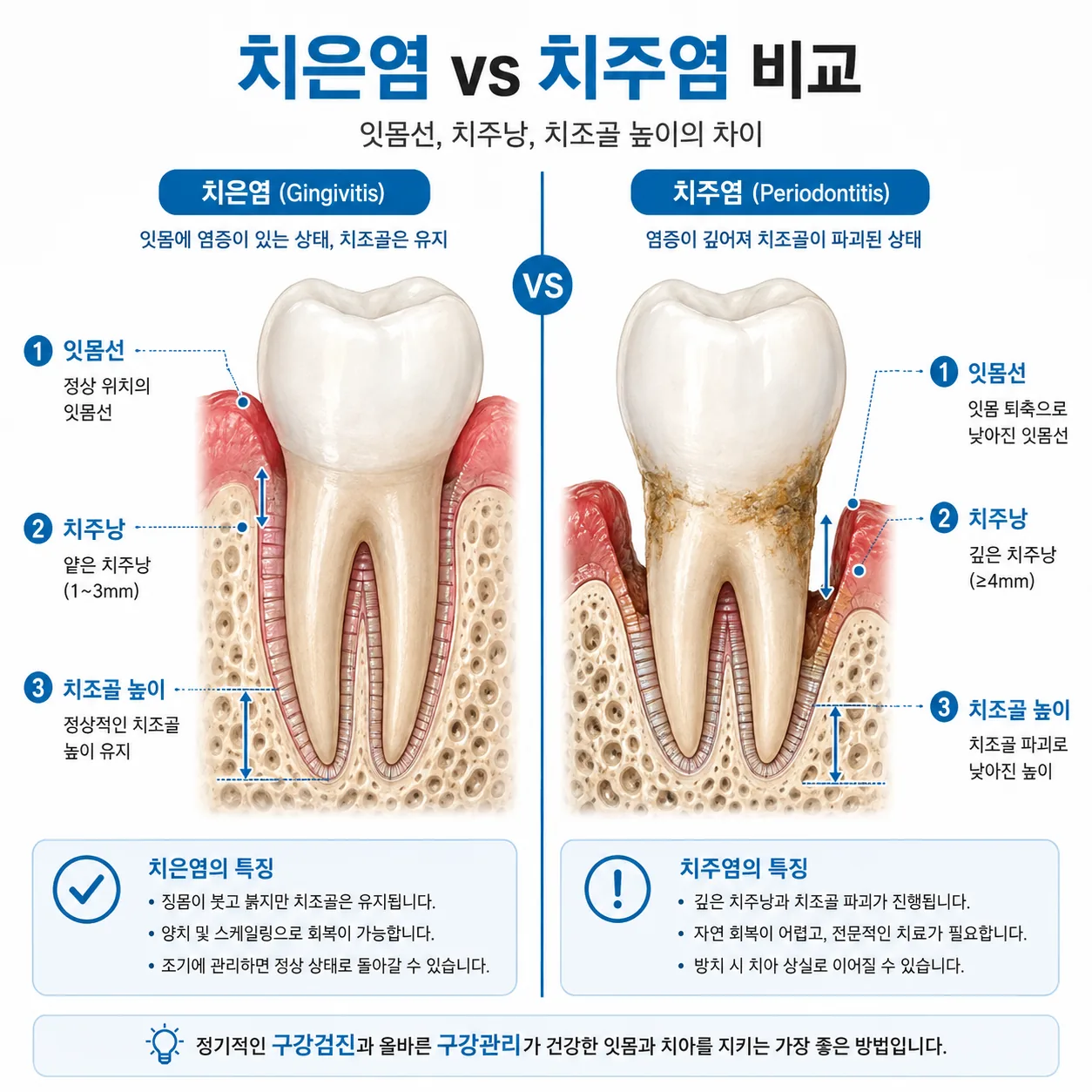 치은염과 치주염의 잇몸 및 치조골 상태 비교