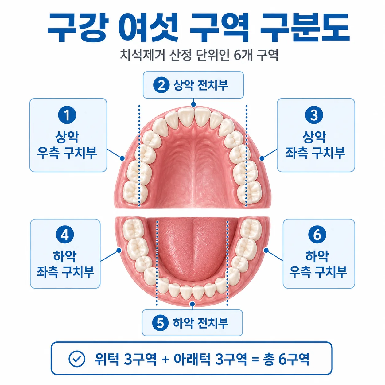 치석제거 산정 단위인 구강 여섯 구역 구분도