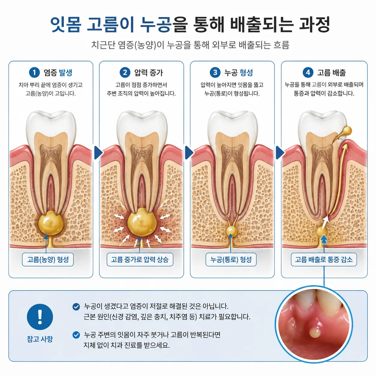 잇몸 고름이 누공으로 배출되는 과정을 보여주는 단면 도해