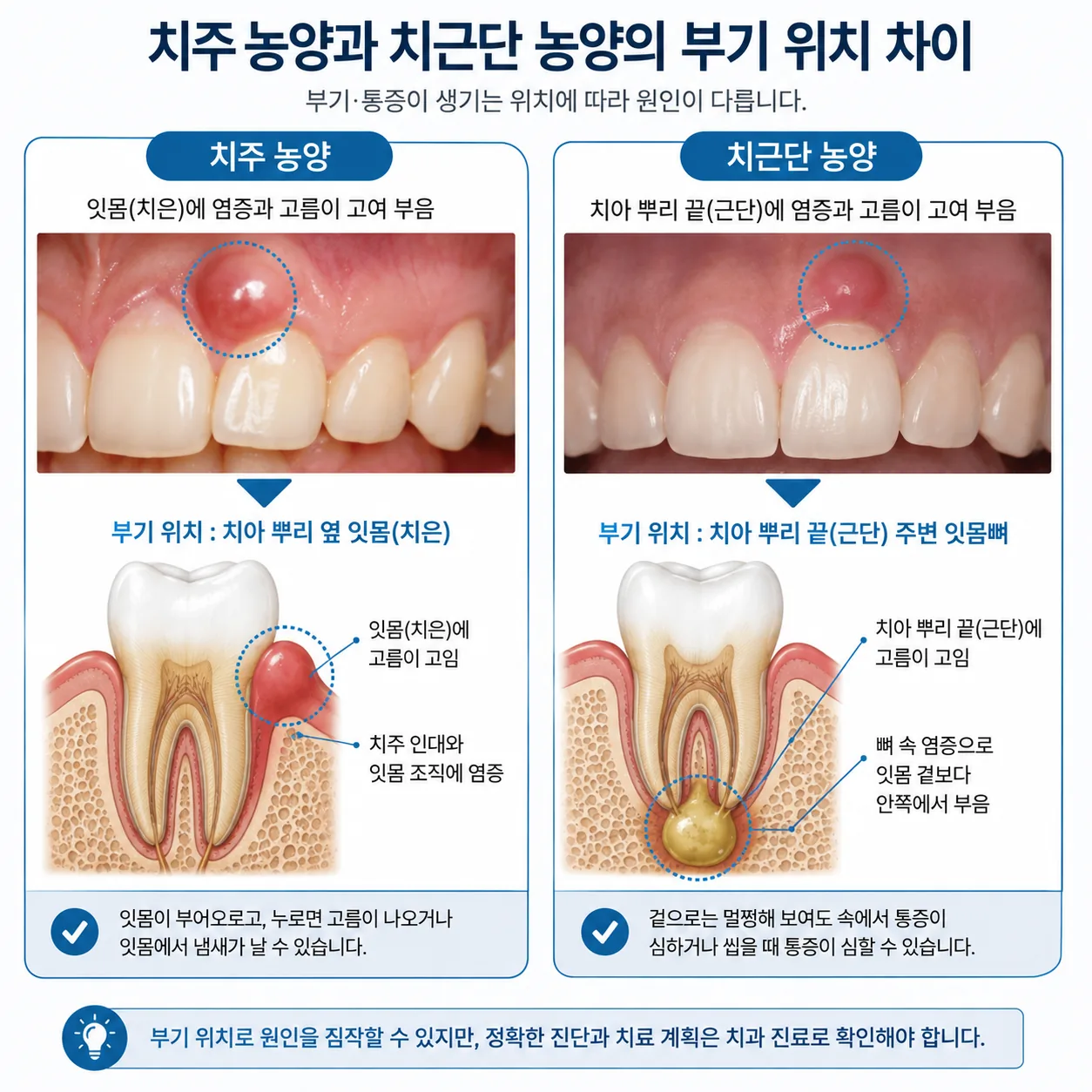 치주 농양과 치근단 농양의 부기 위치 비교 그림