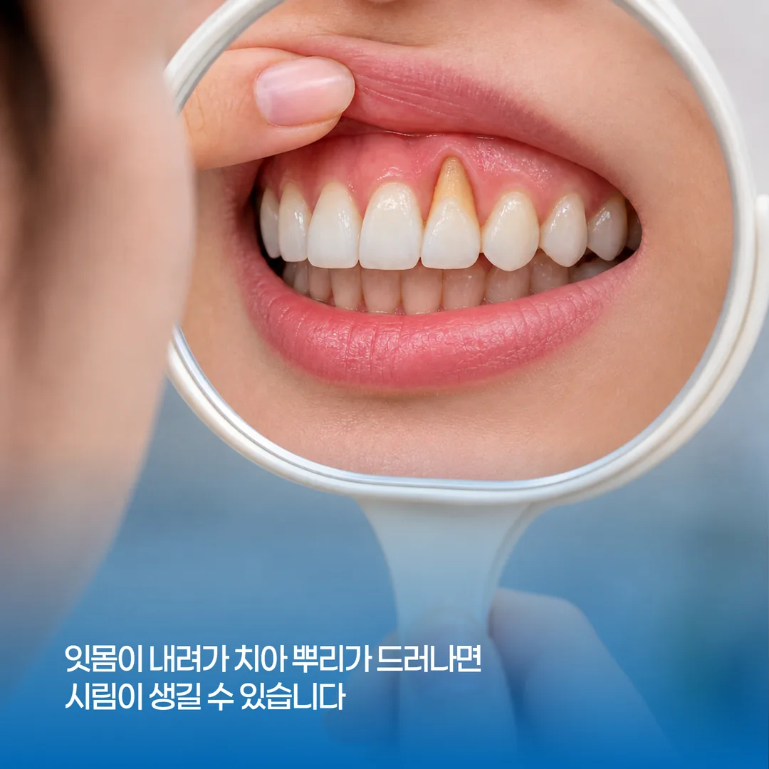 잇몸 퇴축으로 앞니 뿌리가 드러나 치아가 길어 보이는 모습