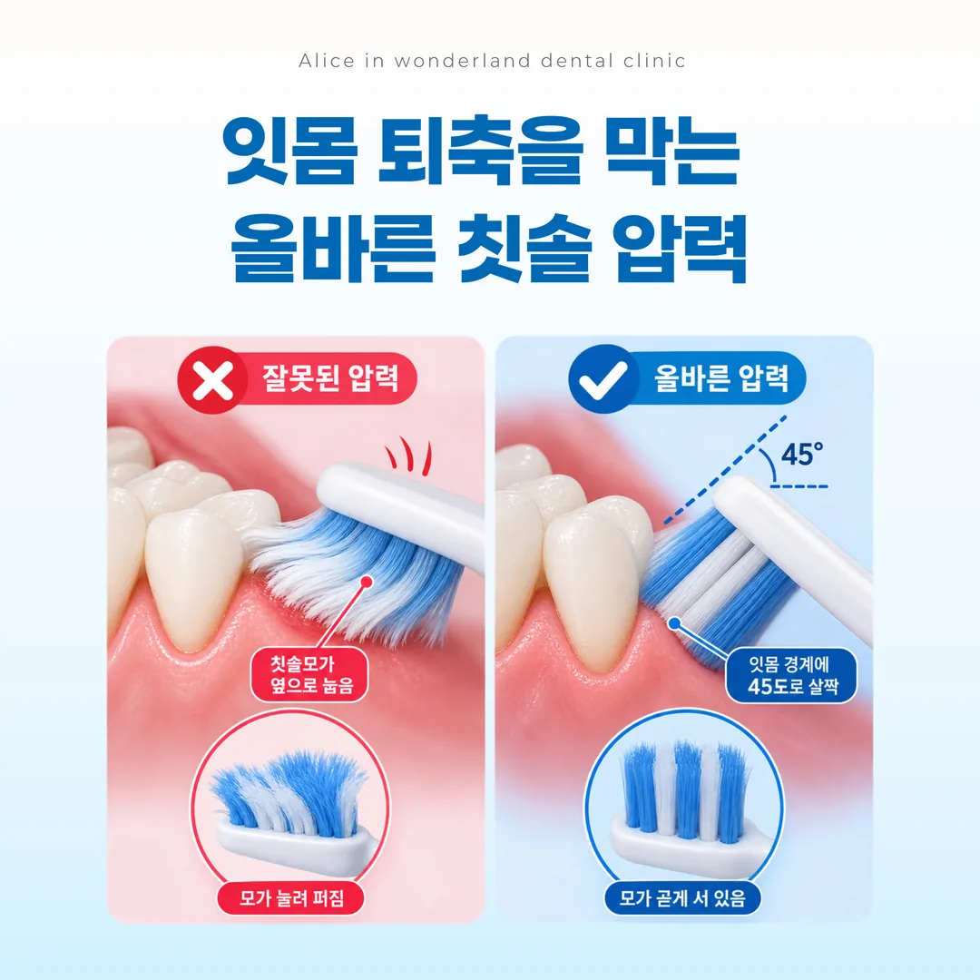 칫솔 압력에 따라 칫솔모가 눕는 모습과 서 있는 모습 비교