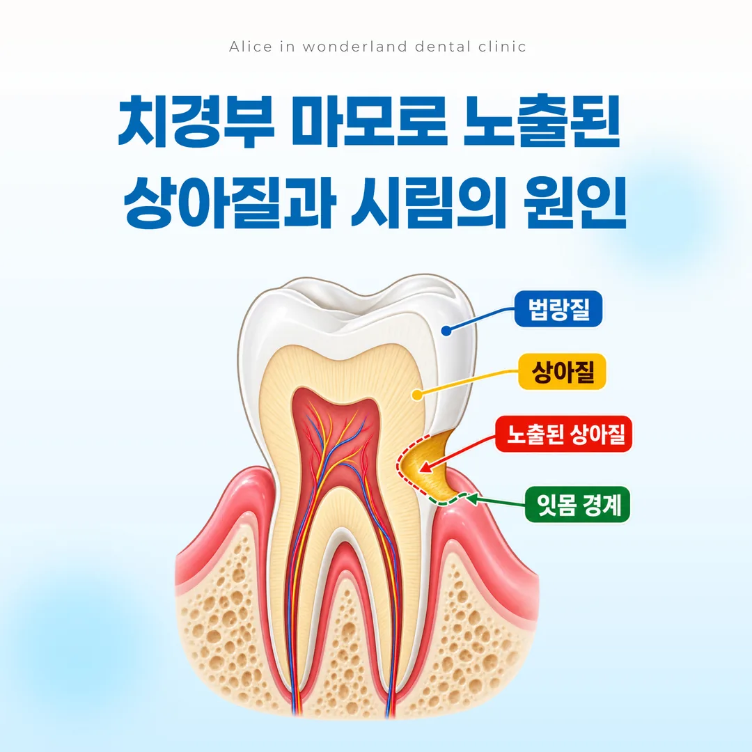 치경부에 쐐기 모양으로 파인 치아 단면과 노출된 상아질을 보여주는 도해