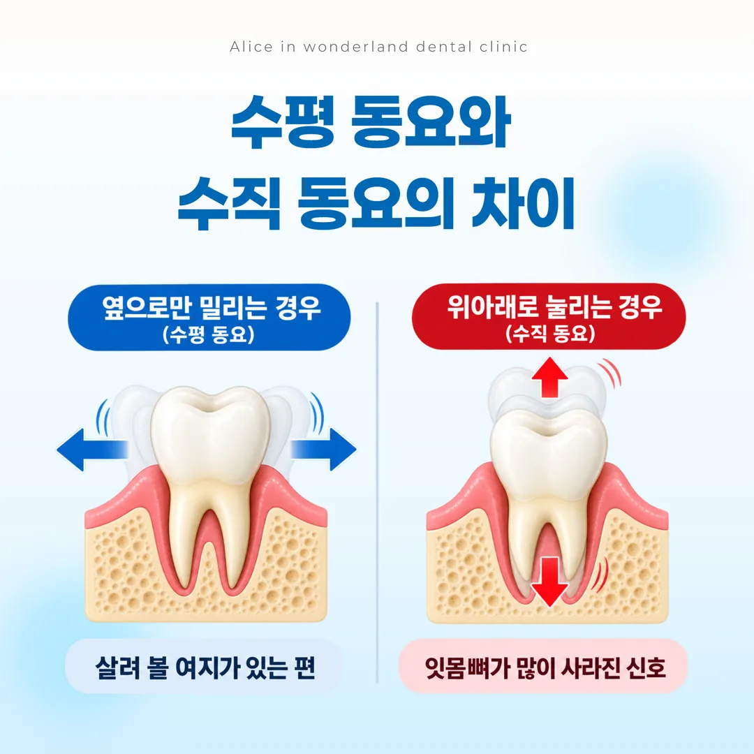 치아 흔들림의 수평 동요와 수직 동요 방향 비교