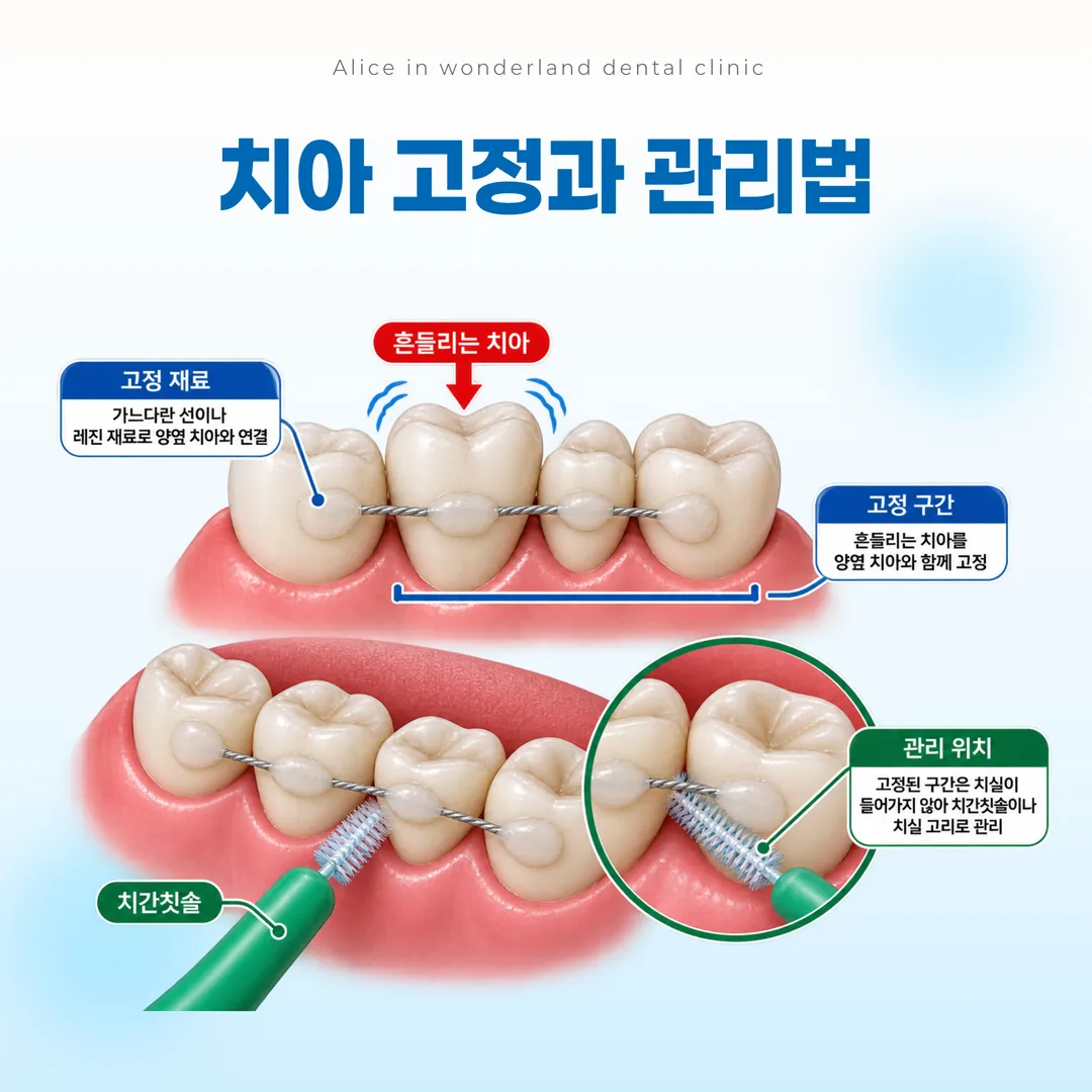 치아 고정 구간과 치간칫솔로 관리하는 위치