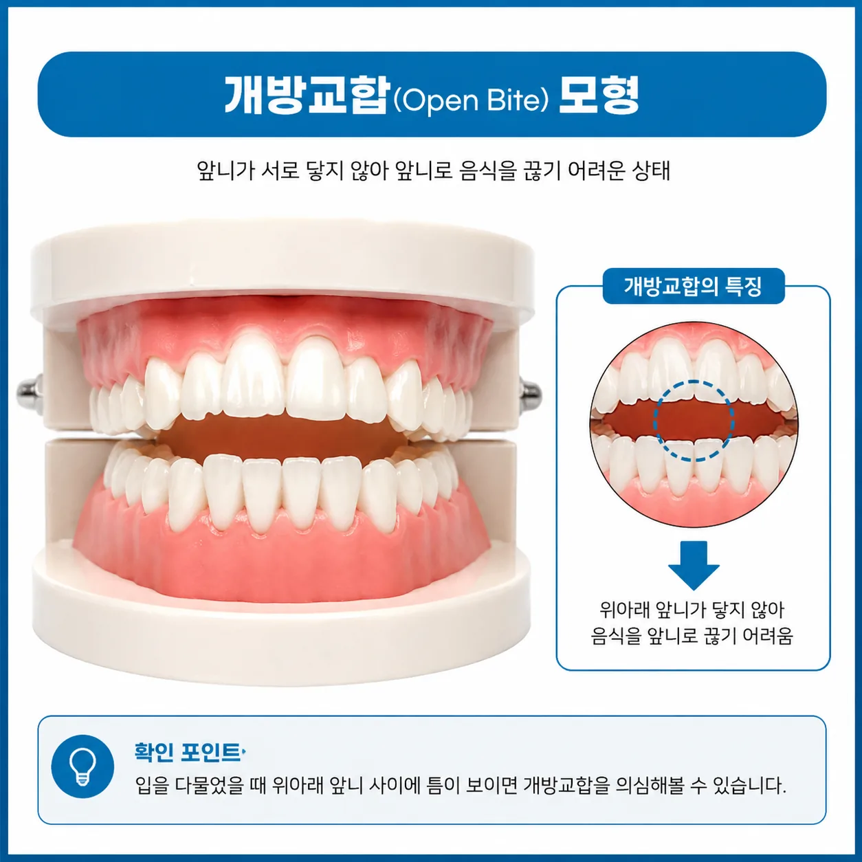 앞니가 닿지 않는 개방교합 맞물림을 보여주는 치아 모형