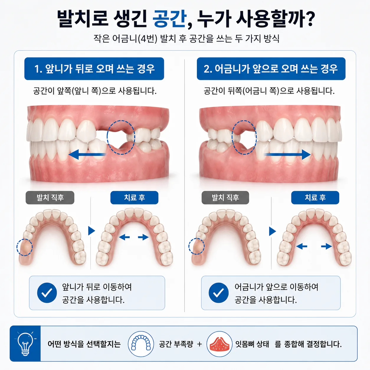 발치로 생긴 공간의 배분을 비교한 교정 계획 도해