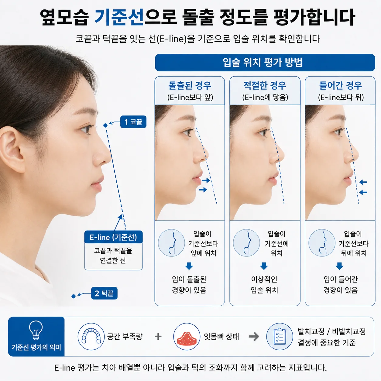 교정 상담에서 돌출 정도를 평가하는 옆모습 기준선 도해