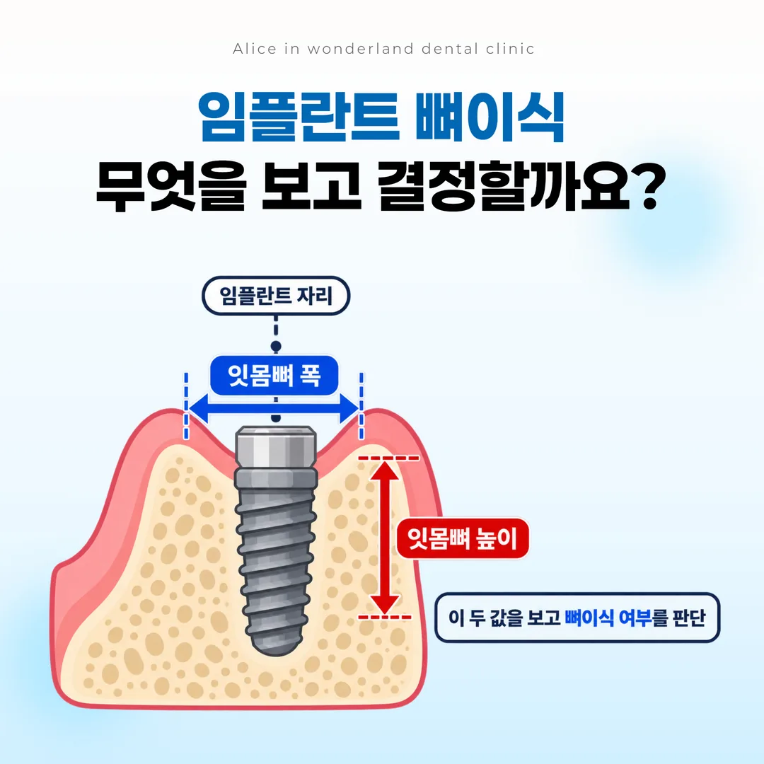 임플란트 뼈이식 판단 기준인 잇몸뼈 폭과 높이 개념도