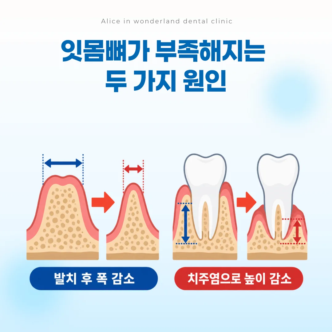 발치 후 폭 감소와 치주염에 의한 높이 감소를 비교한 개념도
