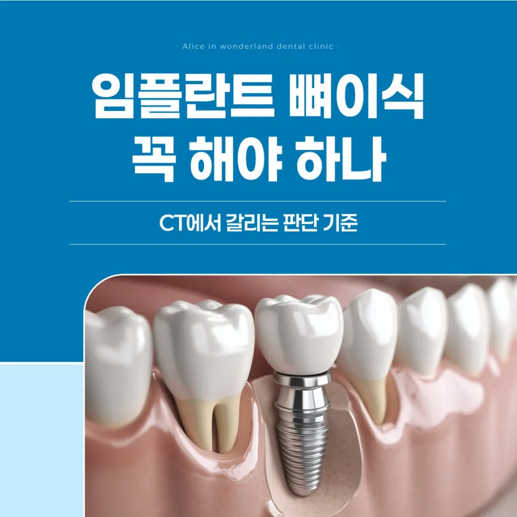 임플란트 뼈이식, 꼭 해야 하나 — CT에서 갈리는 판단 기준