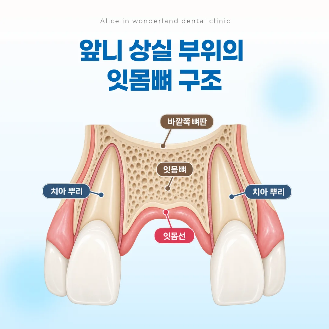 앞니 상실 부위의 잇몸선과 바깥쪽 뼈판 두께를 나타낸 단면 개념도