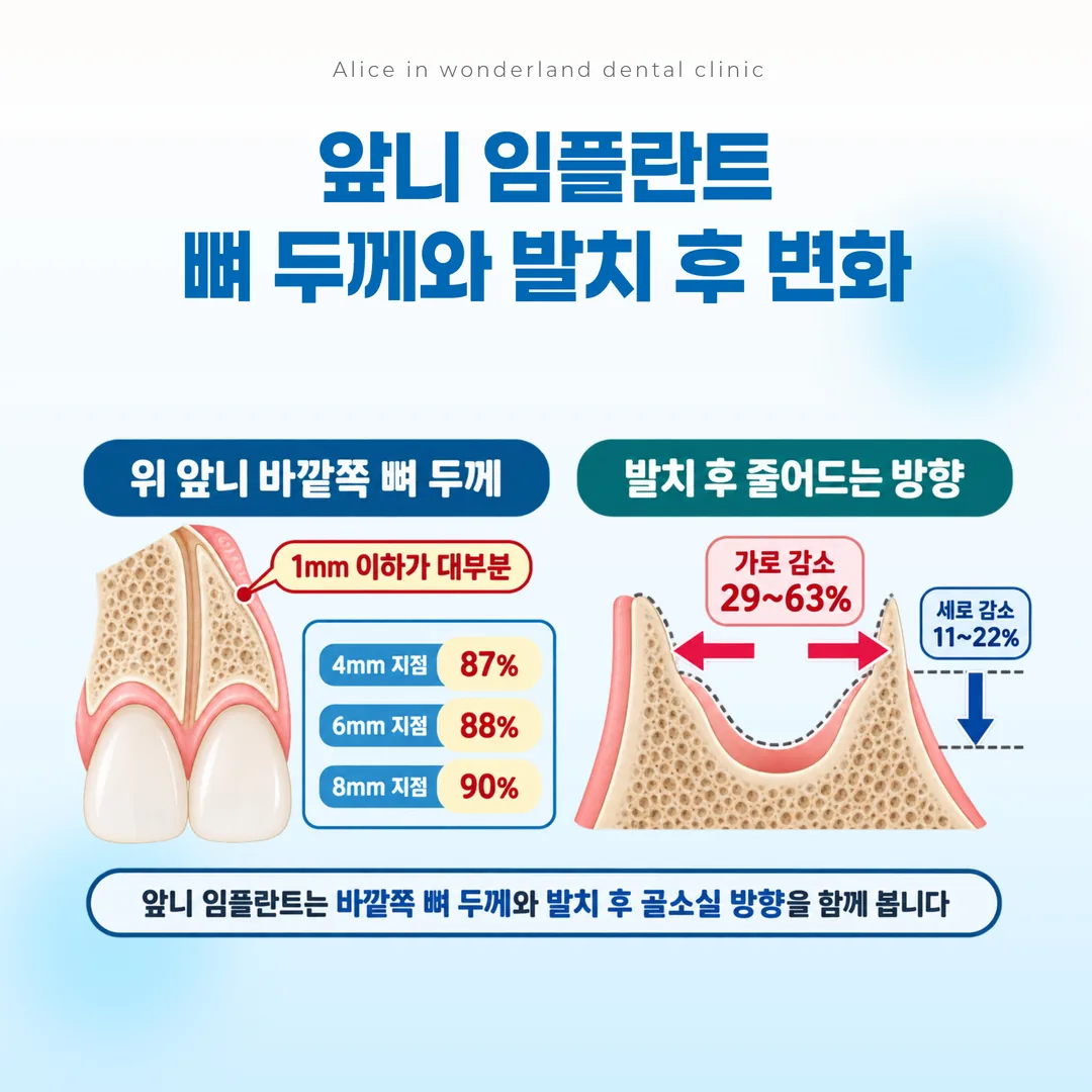 위 앞니 바깥쪽 뼈 두께 분포와 발치 후 줄어드는 방향을 나타낸 개념도