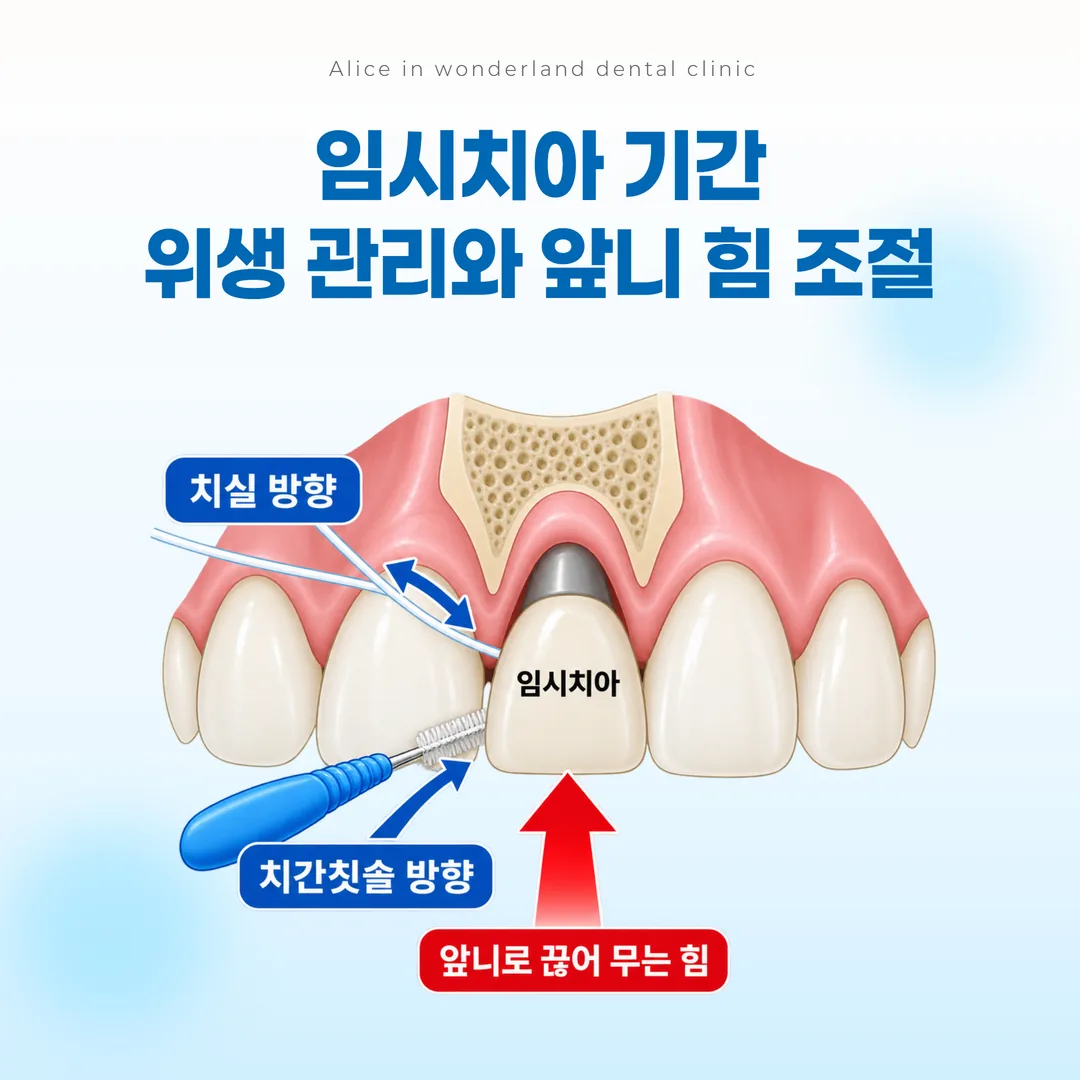 임시치아 기간의 위생 도구 사용 방향과 앞니에 가해지는 힘의 방향을 나타낸 개념도