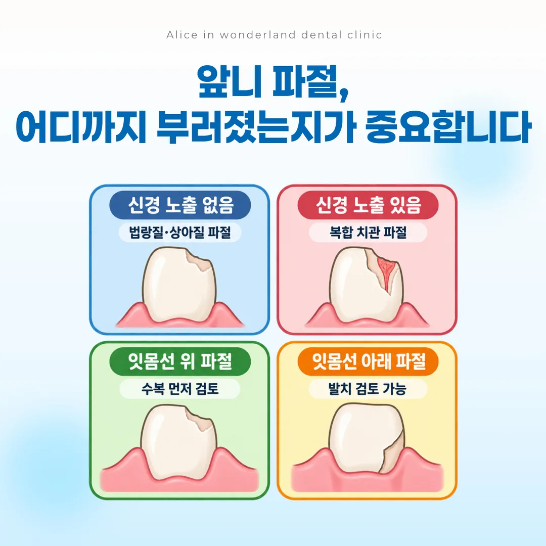 앞니 파절을 신경 노출 여부와 파절선 깊이로 나눈 구분 도표