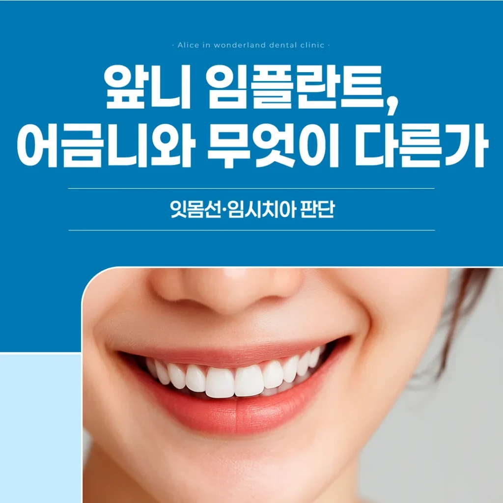 앞니 임플란트, 어금니와 무엇이 다른가 — 잇몸선·임시치아 판단