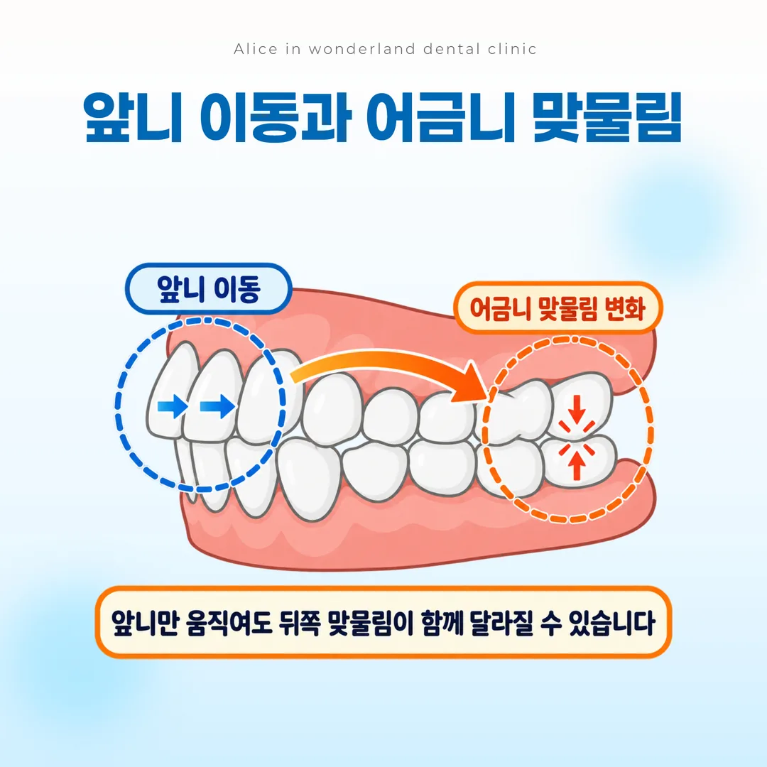 앞니 이동이 어금니 맞물림에 영향을 주는 관계 모식도