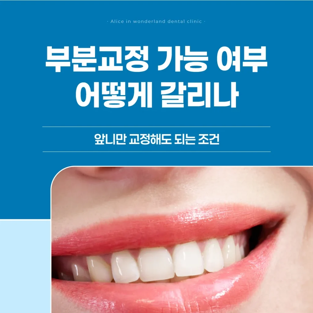 부분교정 가능 여부, 어떻게 갈리나 — 앞니만 교정해도 되는 조건