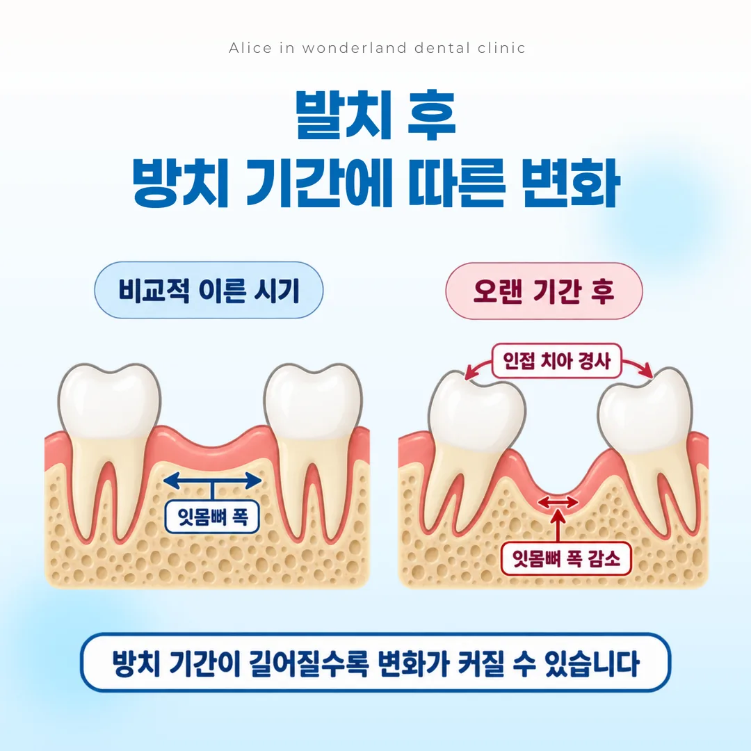 발치 후 방치 기간에 따라 달라지는 잇몸뼈와 인접 치아 상태 개념도