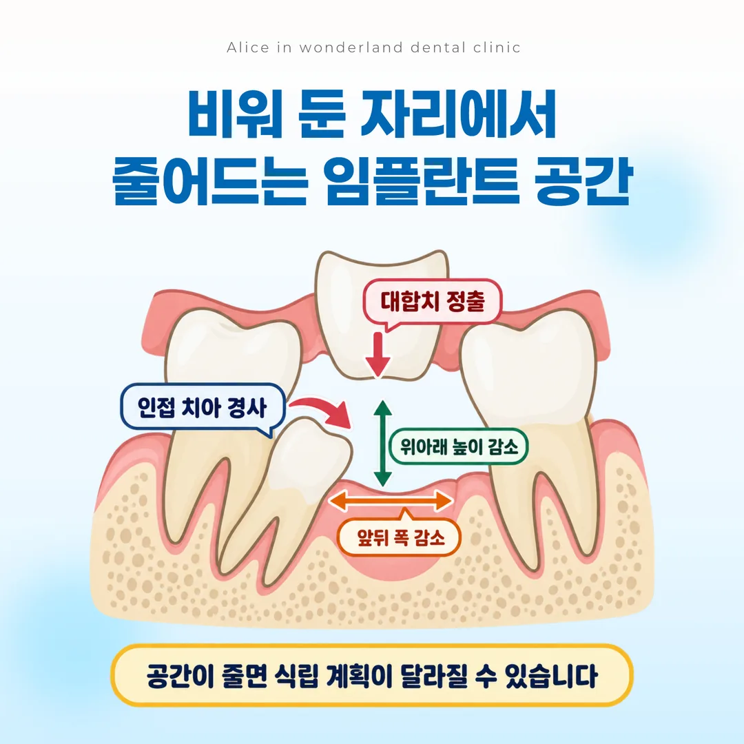 인접 치아 경사와 대합치 정출로 좁아진 임플란트 공간을 나타낸 도해