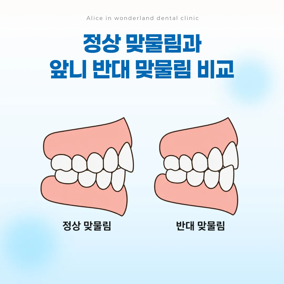 정상 맞물림과 앞니 반대 맞물림을 옆에서 비교한 개념도