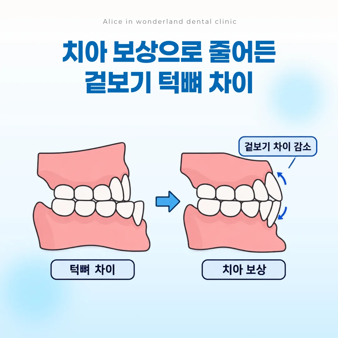 앞니 보상으로 겉보기 반대 맞물림이 줄어드는 원리를 나타낸 도해
