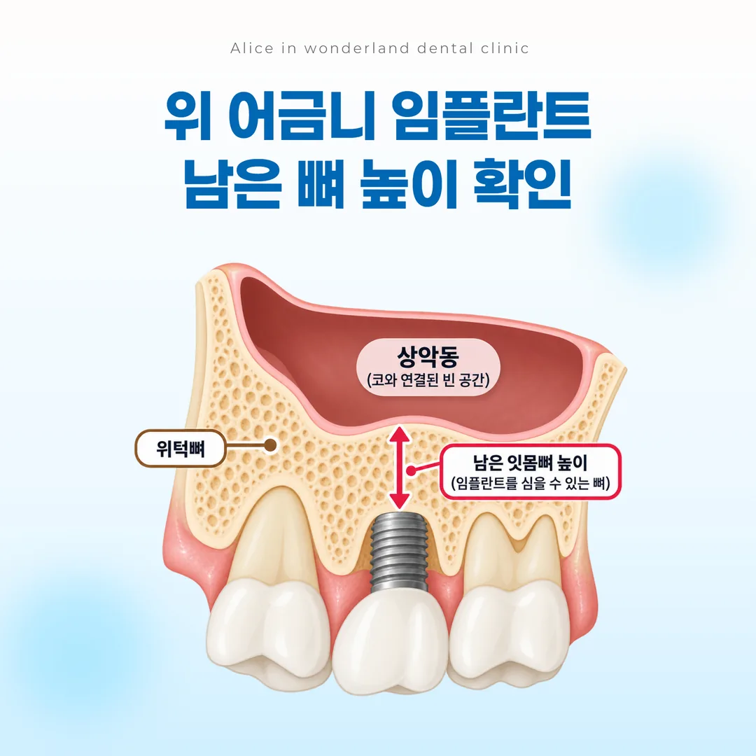 위 어금니 자리에서 상악동 바닥까지 남은 잇몸뼈 높이를 표시한 개념도