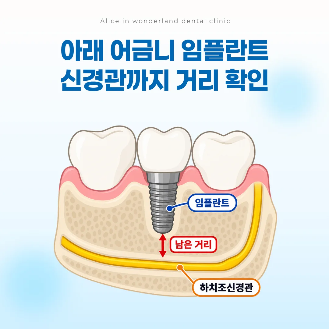 아래 어금니 자리에서 하치조신경관까지 남은 거리를 표시한 개념도