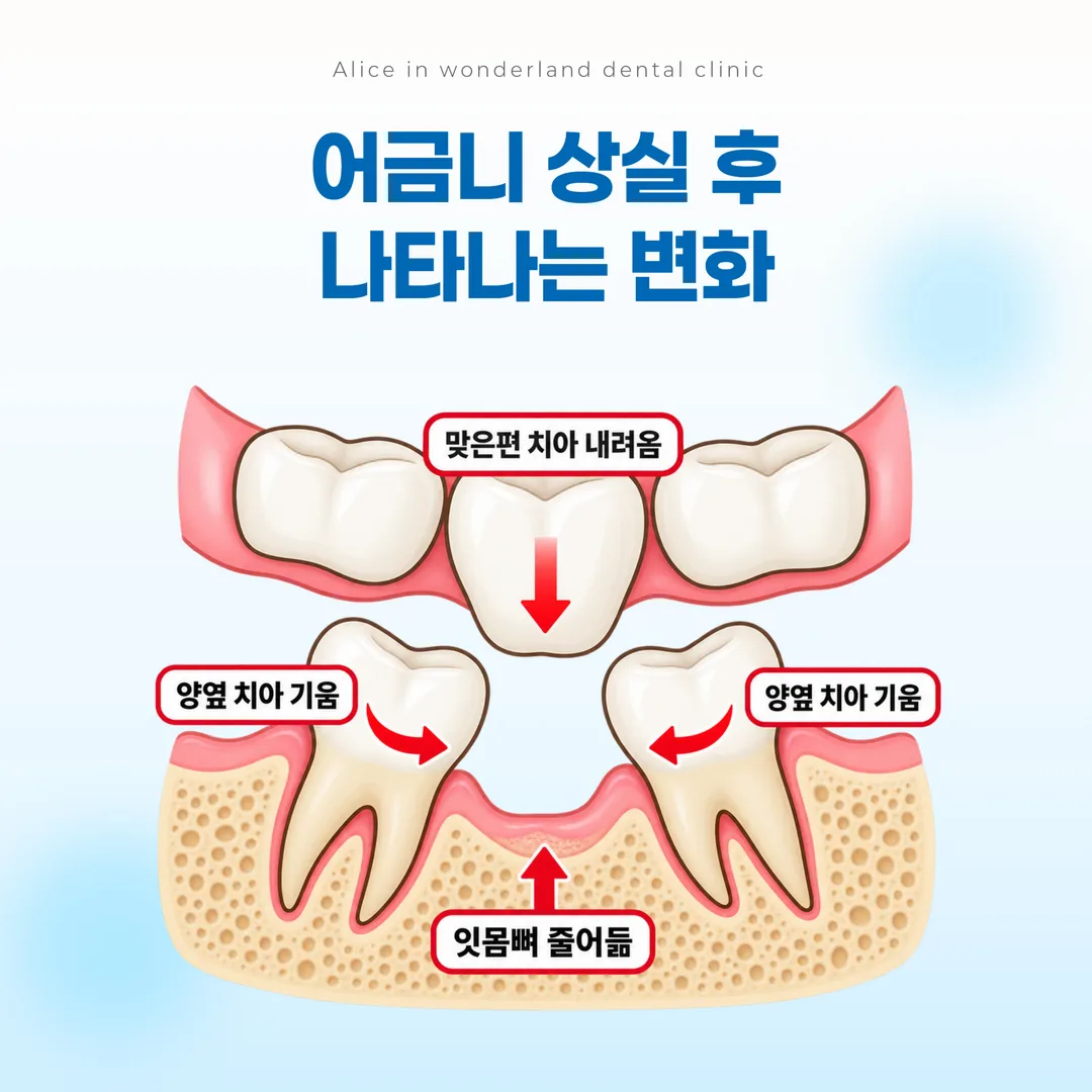 어금니 상실을 오래 방치할 때 생기는 대합치 정출과 인접치 경사를 나타낸 개념도