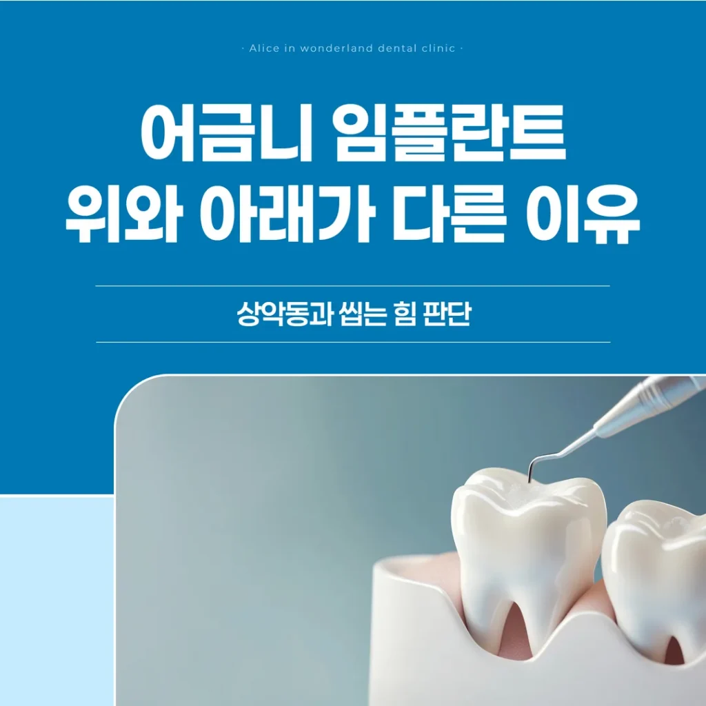 어금니 임플란트, 위와 아래가 다른 이유 — 상악동과 씹는 힘 판단