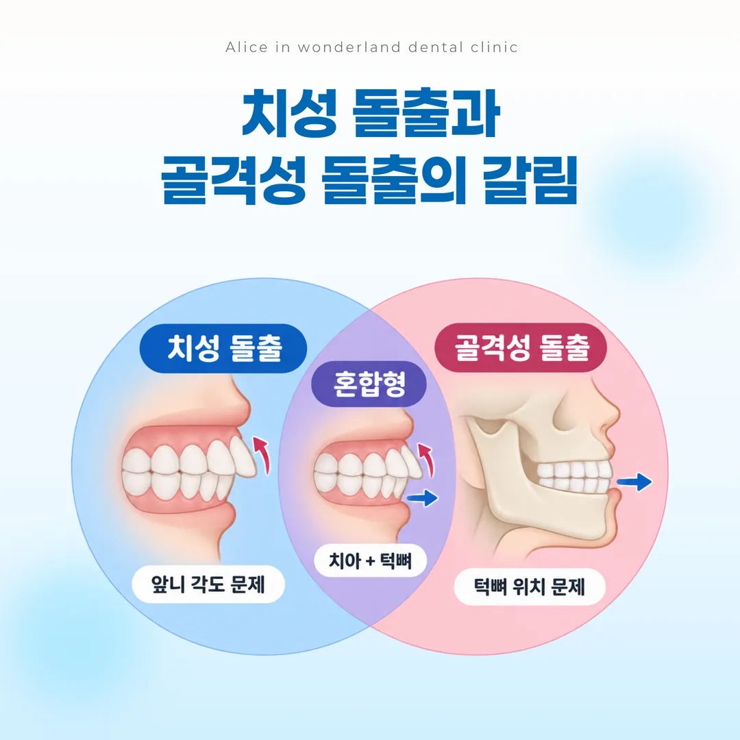 치성 돌출과 골격성 돌출의 갈림을 나타낸 개념도