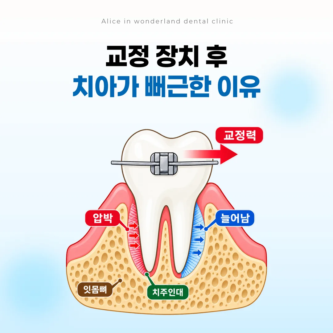 교정 장치의 힘이 치주인대에 실리면서 압박감이 생기는 과정을 나타낸 단면 개념도