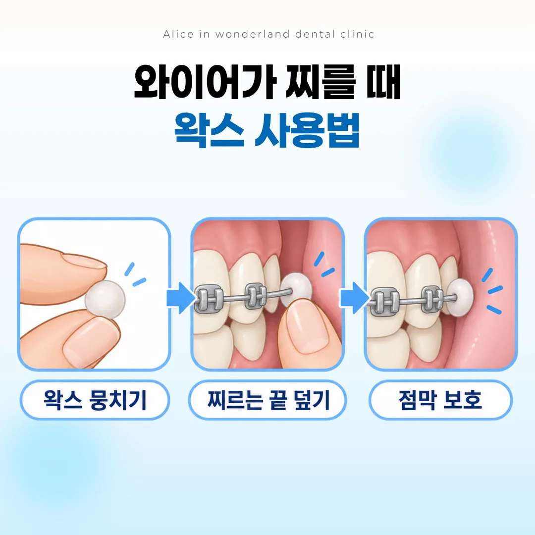 와이어 끝을 교정용 왁스로 덮어 점막을 보호하는 임시 대처 설명 그림
