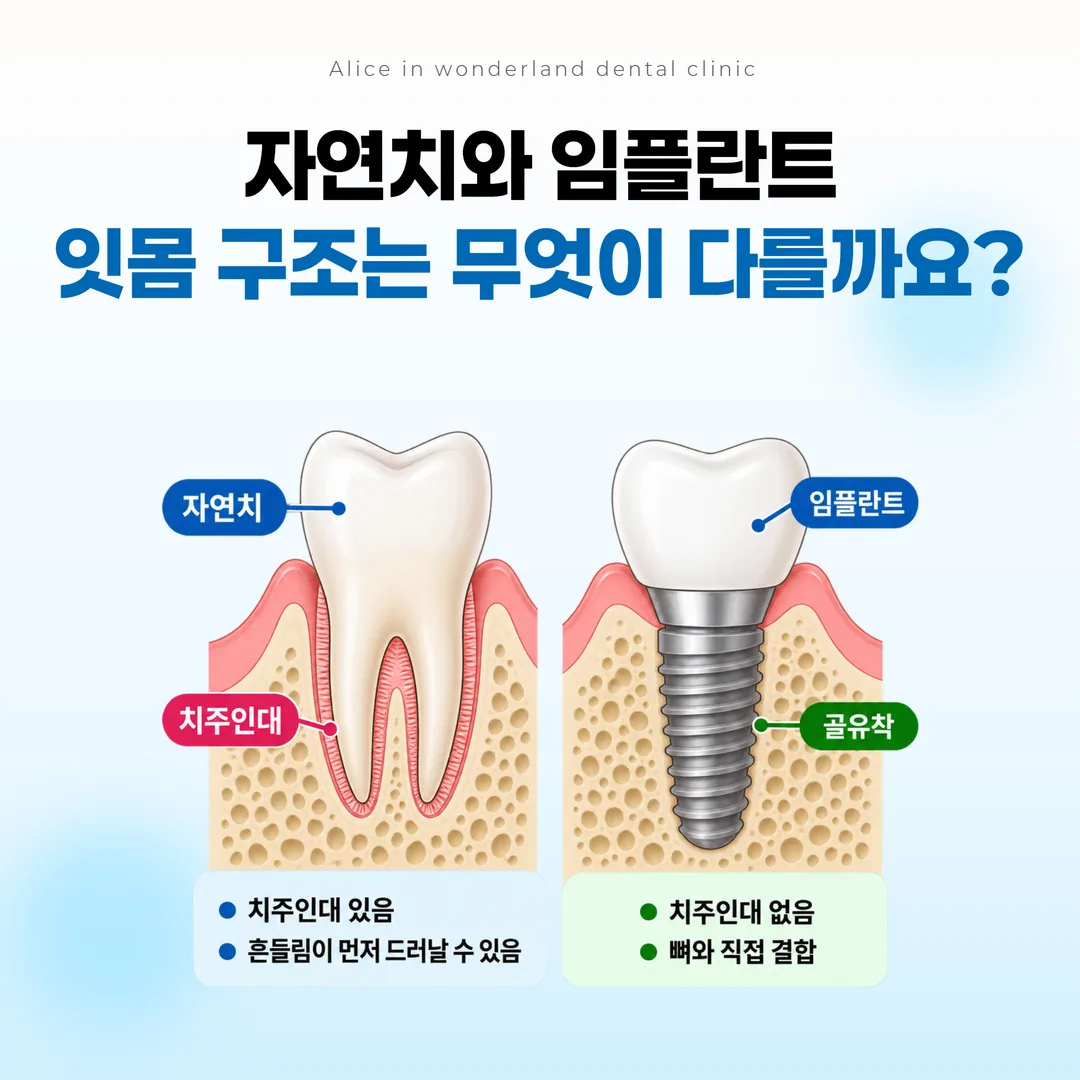 자연치의 치주인대 구조와 임플란트의 골유착 구조를 비교한 단면 개념도