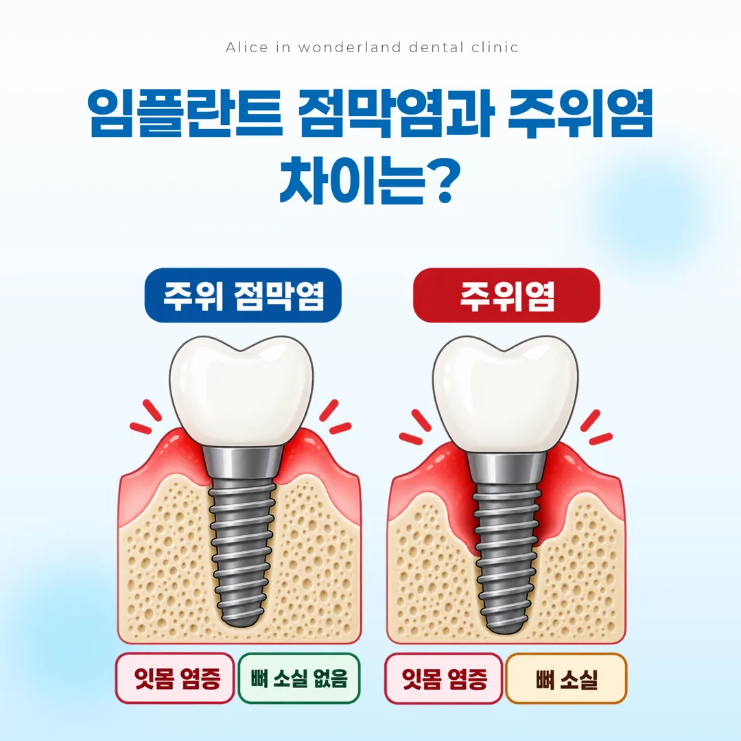 임플란트 주위 점막염 단계와 임플란트 주위염 단계를 비교한 진행 단계 도해