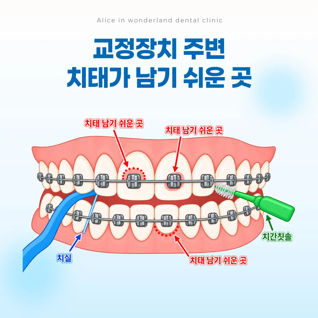 교정장치 주변 치태가 남기 쉬운 부위와 구강위생 보조도구가 닿는 부위를 표시한 그림
