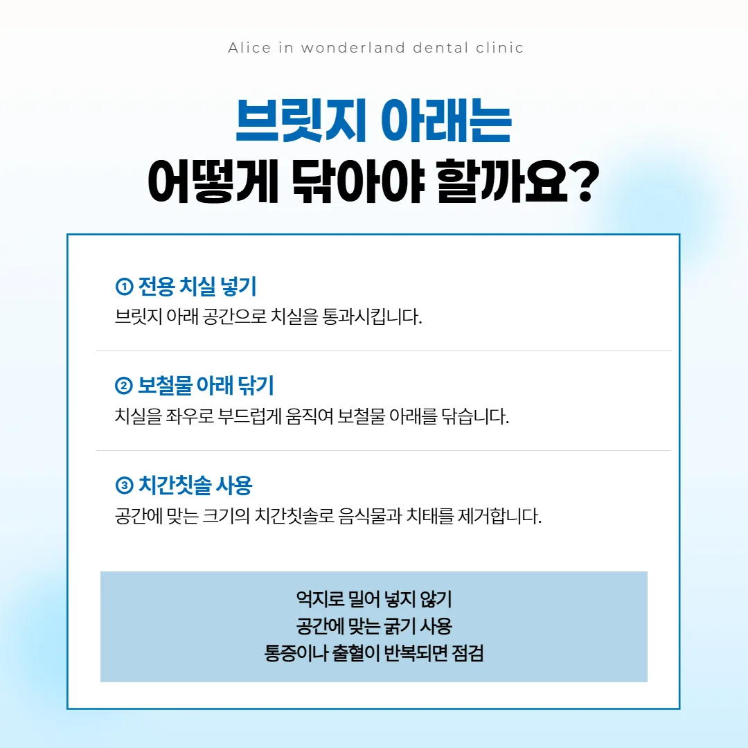 브릿지 보철물 아래를 전용 치실과 치간칫솔로 청소하는 방법 안내 그림