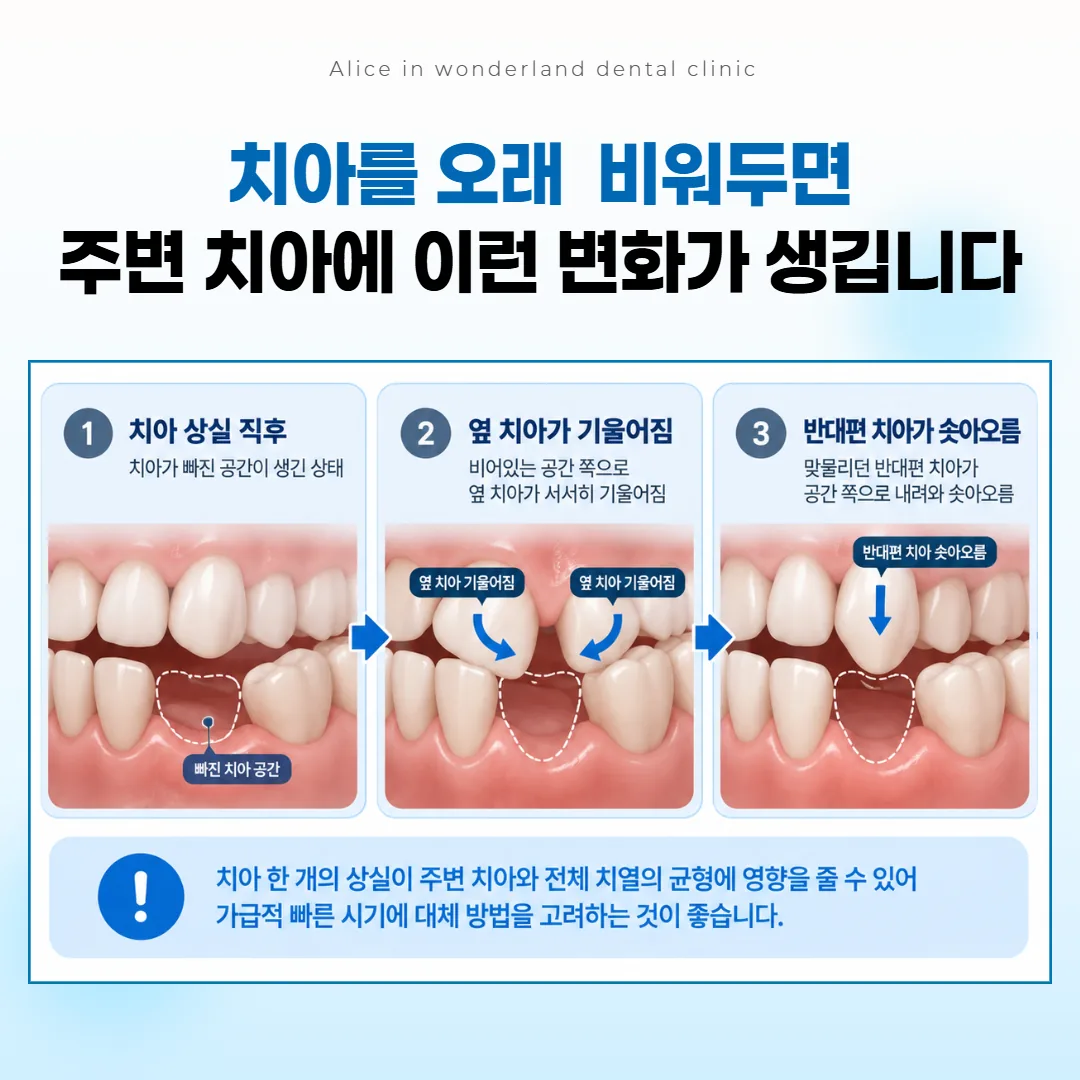 치아 상실 부위를 방치했을 때 인접 치아가 기울고 대합치가 솟아오르는 변화 그림