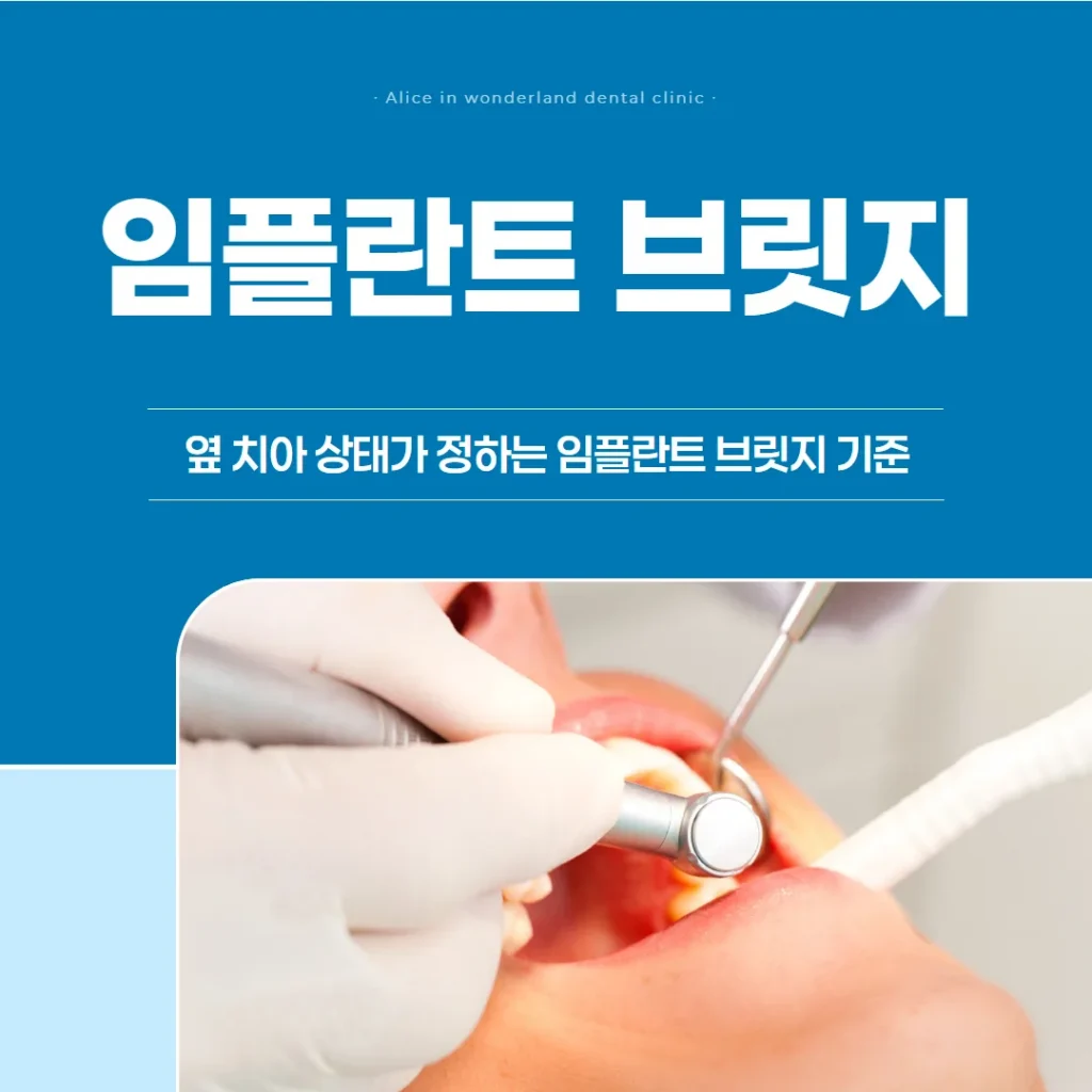임플란트 브릿지 선택, 무엇으로 갈리나 — 옆 치아 상태가 정하는 기준