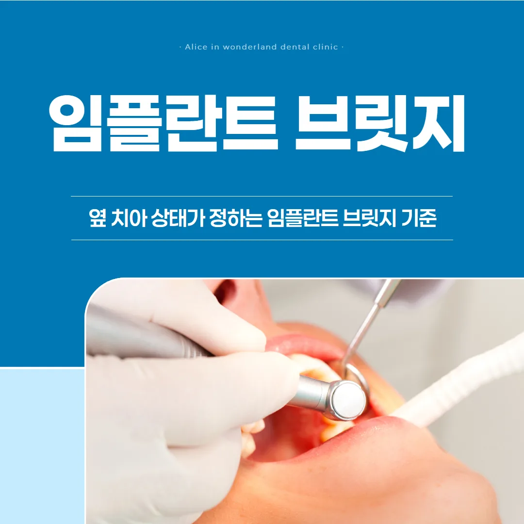임플란트 브릿지 선택, 무엇으로 갈리나 — 옆 치아 상태가 정하는 기준
