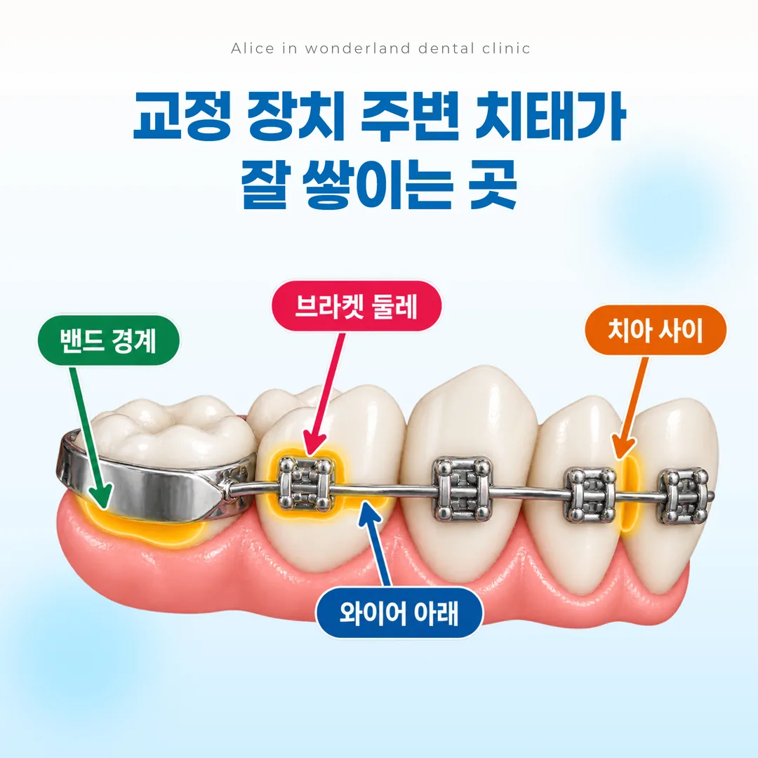 교정 브라켓 주변에 치태가 모이기 쉬운 부위를 표시한 도식